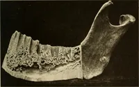 An illustration from Oral Roentgenology : a Roentgen study of the anatomy and pathology of the oral cavity (1917)