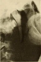 An illustration from Oral Roentgenology : a Roentgen study of the anatomy and pathology of the oral cavity (1917)