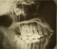 An illustration from Oral Roentgenology : a Roentgen study of the anatomy and pathology of the oral cavity (1917)