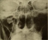 An illustration from Oral Roentgenology : a Roentgen study of the anatomy and pathology of the oral cavity (1917)
