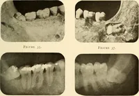 Picture 29 of 158 from Oral Roentgenology : a Roentgen study of the anatomy and pathology of the oral cavity (1917), leaf 62