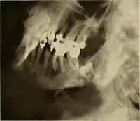 Picture 30 of 158 from Oral Roentgenology : a Roentgen study of the anatomy and pathology of the oral cavity (1917), leaf 62