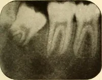 Picture 31 of 158 from Oral Roentgenology : a Roentgen study of the anatomy and pathology of the oral cavity (1917), leaf 64