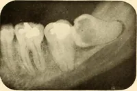 Picture 33 of 158 from Oral Roentgenology : a Roentgen study of the anatomy and pathology of the oral cavity (1917), leaf 66
