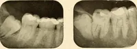 Picture 34 of 158 from Oral Roentgenology : a Roentgen study of the anatomy and pathology of the oral cavity (1917), leaf 66