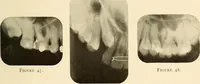 An illustration from Oral Roentgenology : a Roentgen study of the anatomy and pathology of the oral cavity (1917)