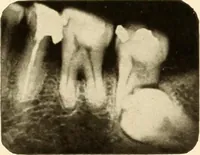 Picture 36 of 158 from Oral Roentgenology : a Roentgen study of the anatomy and pathology of the oral cavity (1917), leaf 68