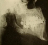 Picture 37 of 158 from Oral Roentgenology : a Roentgen study of the anatomy and pathology of the oral cavity (1917), leaf 68