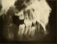 Picture 38 of 158 from Oral Roentgenology : a Roentgen study of the anatomy and pathology of the oral cavity (1917), leaf 70