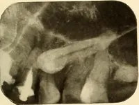 An illustration from Oral Roentgenology : a Roentgen study of the anatomy and pathology of the oral cavity (1917)