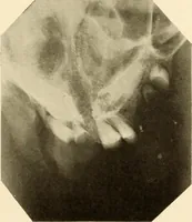 An illustration from Oral Roentgenology : a Roentgen study of the anatomy and pathology of the oral cavity (1917)