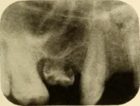 An illustration from Oral Roentgenology : a Roentgen study of the anatomy and pathology of the oral cavity (1917)