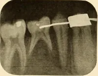 Picture 44 of 158 from Oral Roentgenology : a Roentgen study of the anatomy and pathology of the oral cavity (1917), leaf 74
