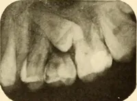 Picture 45 of 158 from Oral Roentgenology : a Roentgen study of the anatomy and pathology of the oral cavity (1917), leaf 76