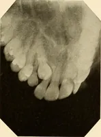 An illustration from Oral Roentgenology : a Roentgen study of the anatomy and pathology of the oral cavity (1917)