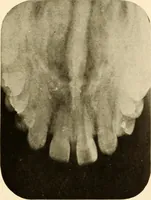 An illustration from Oral Roentgenology : a Roentgen study of the anatomy and pathology of the oral cavity (1917)