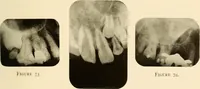 An illustration from Oral Roentgenology : a Roentgen study of the anatomy and pathology of the oral cavity (1917)