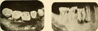 An illustration from Oral Roentgenology : a Roentgen study of the anatomy and pathology of the oral cavity (1917)