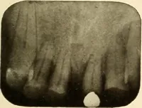 Picture 50 of 158 from Oral Roentgenology : a Roentgen study of the anatomy and pathology of the oral cavity (1917), leaf 82