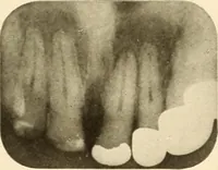 Picture 51 of 158 from Oral Roentgenology : a Roentgen study of the anatomy and pathology of the oral cavity (1917), leaf 82