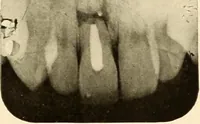 Picture 52 of 158 from Oral Roentgenology : a Roentgen study of the anatomy and pathology of the oral cavity (1917), leaf 84