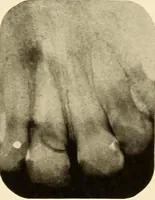 An illustration from Oral Roentgenology : a Roentgen study of the anatomy and pathology of the oral cavity (1917)