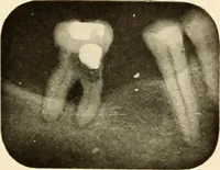 Picture 55 of 158 from Oral Roentgenology : a Roentgen study of the anatomy and pathology of the oral cavity (1917), leaf 86