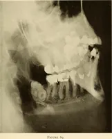 Picture 57 of 158 from Oral Roentgenology : a Roentgen study of the anatomy and pathology of the oral cavity (1917), leaf 88