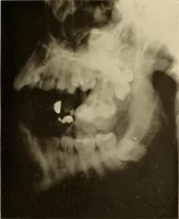An illustration from Oral Roentgenology : a Roentgen study of the anatomy and pathology of the oral cavity (1917)