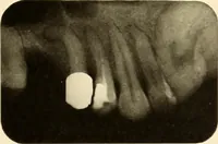 An illustration from Oral Roentgenology : a Roentgen study of the anatomy and pathology of the oral cavity (1917)