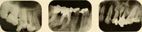 Picture 61 of 158 from Oral Roentgenology : a Roentgen study of the anatomy and pathology of the oral cavity (1917), leaf 96