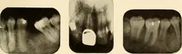 Picture 62 of 158 from Oral Roentgenology : a Roentgen study of the anatomy and pathology of the oral cavity (1917), leaf 96