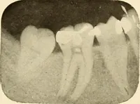 Picture 65 of 158 from Oral Roentgenology : a Roentgen study of the anatomy and pathology of the oral cavity (1917), leaf 98
