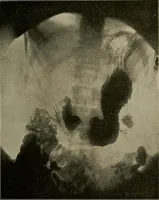 An illustration from Paragon X-ray pointers : a complete textbook on radiography with Paragon X-ray plates (1915)