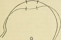 Picture 77 of 80 from Phrenologische Bilder : zur Naturlehre des menschlichen Geistes und deren Anwendung Wissenschaft und Leben (1855), leaf 472