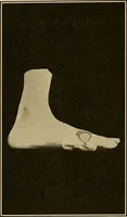 An illustration from Practical podiatry : (1918)