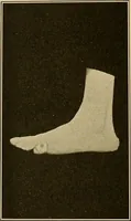 An illustration from Practical podiatry : (1918)