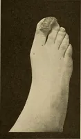 An illustration from Practical podiatry : (1918)