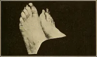 An illustration from Practical podiatry : (1918)