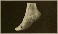 An illustration from Practical podiatry : (1918)
