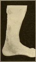 An illustration from Practical podiatry : (1918)