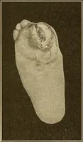 Picture 38 of 44 from Practical podiatry : (1918), leaf 338