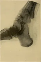 An illustration from Practical podiatry : (1918)