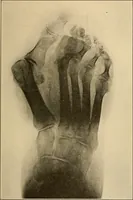 An illustration from Practical podiatry : (1918)