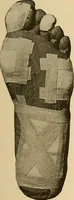 Picture 4 of 44 from Practical podiatry : (1918), leaf 80