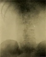 An illustration from Practical radiography : a handbook for physicians, surgeons, and other users of X-rays (1901)