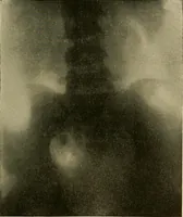 An illustration from Practical radiography : a handbook for physicians, surgeons, and other users of X-rays (1901)
