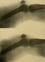 Picture 22 of 86 from Practical radiography : a handbook for physicians, surgeons, and other users of X-rays (1901), leaf 79