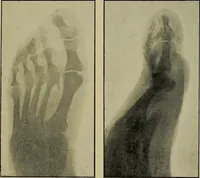 Picture 7 of 43 from Practical X ray work (1901), leaf 48