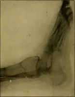 An illustration from Radiography and the 'X' rays in practice and theory : with constructional manipulatory details (1898)